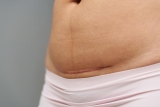 Comment perdre du ventre après une hystérectomie ?